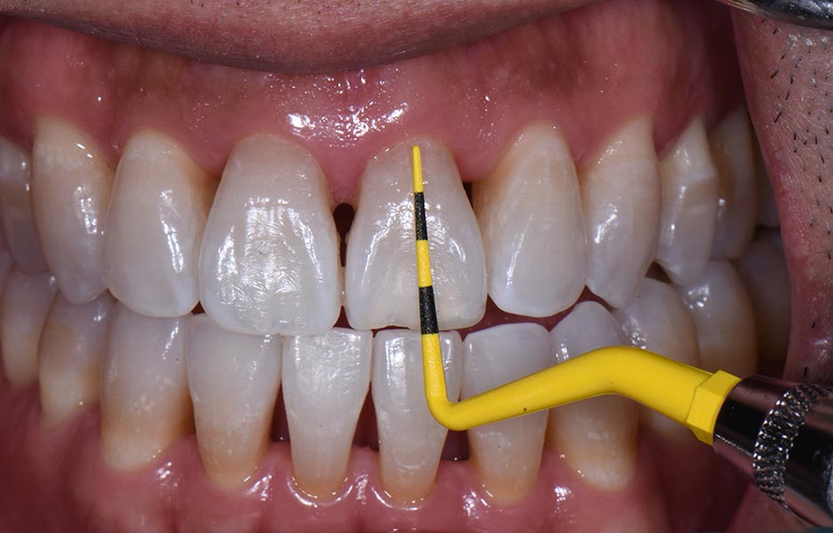 How Bioclear Empowers Dentists To Treat Black Triangles Optident